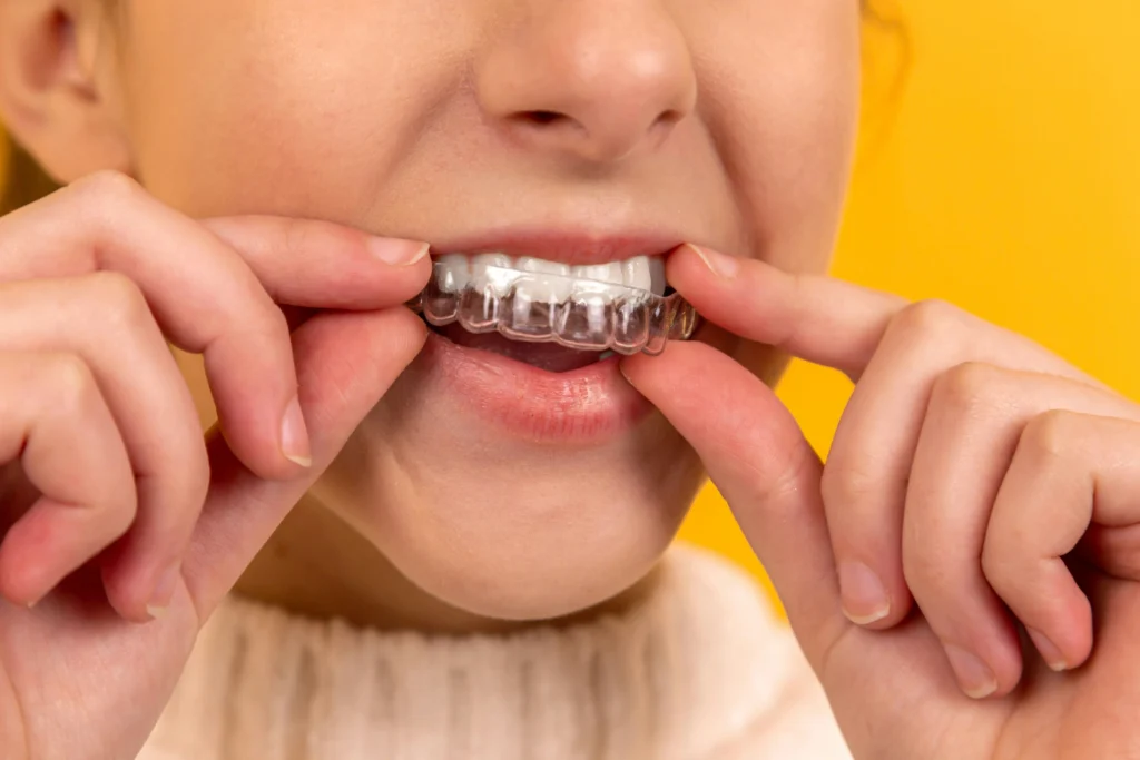 An image of dental braces illustrating whether Invisalign is worth it