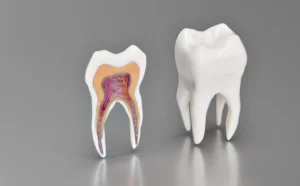 A detailed medical model of wisdom tooth anatomy