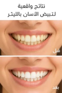 صورة لاسنان قبل وبعد تبييض الاسنان توضح الفارق الذي يصنعه تبييض الاسنان