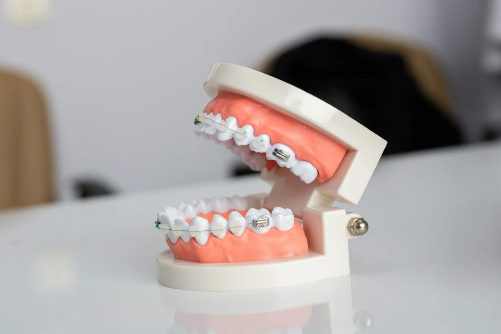 Image of a model of teeth and braces showing how to use Invisalign Fix Overbite.