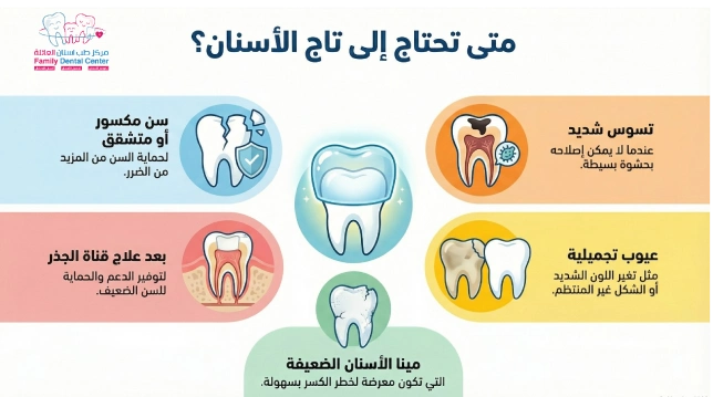 متى تحتاج إلى تلبيسات الأسنان