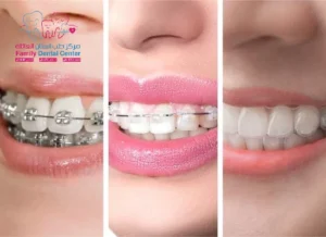 Transparent Clip for Teeth