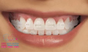 Braces Invisible Price