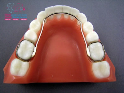 احد اشكال مثبت الاسنان الحديد من منظور افقي