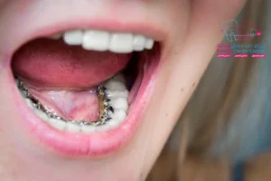 التقويم الداخلي للاسنان