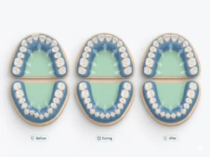 clear aligners crowded teeth oman